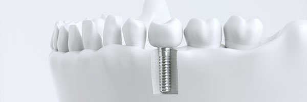 Zahnarztpraxis Dr. Seidel Plauen - Implantologie